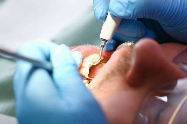 Best Emergency Wisdom Tooth Extraction in River Road, NC